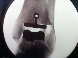 total ankle replacment2