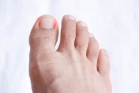 When Should I See a Doctor for My Ingrown Toenail?