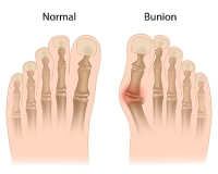Understanding What Bunions Are