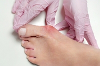 Relief Options for Bunions