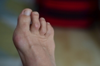 What Is Hammertoe?