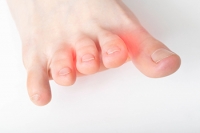 Treatment Options Differ for Mild and Severe Morton’s Neuroma