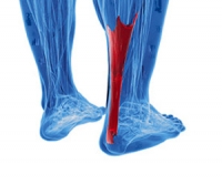 Wearing Specific Shoes May Cause an Achilles Tendon Injury